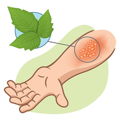 Plant rashes