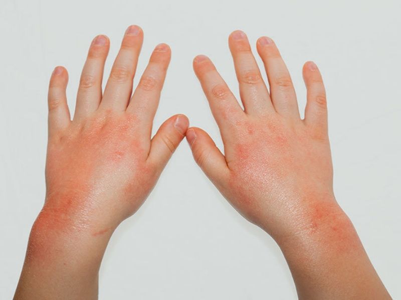 Watch Out For Summer Rashes In Kids Educationworld